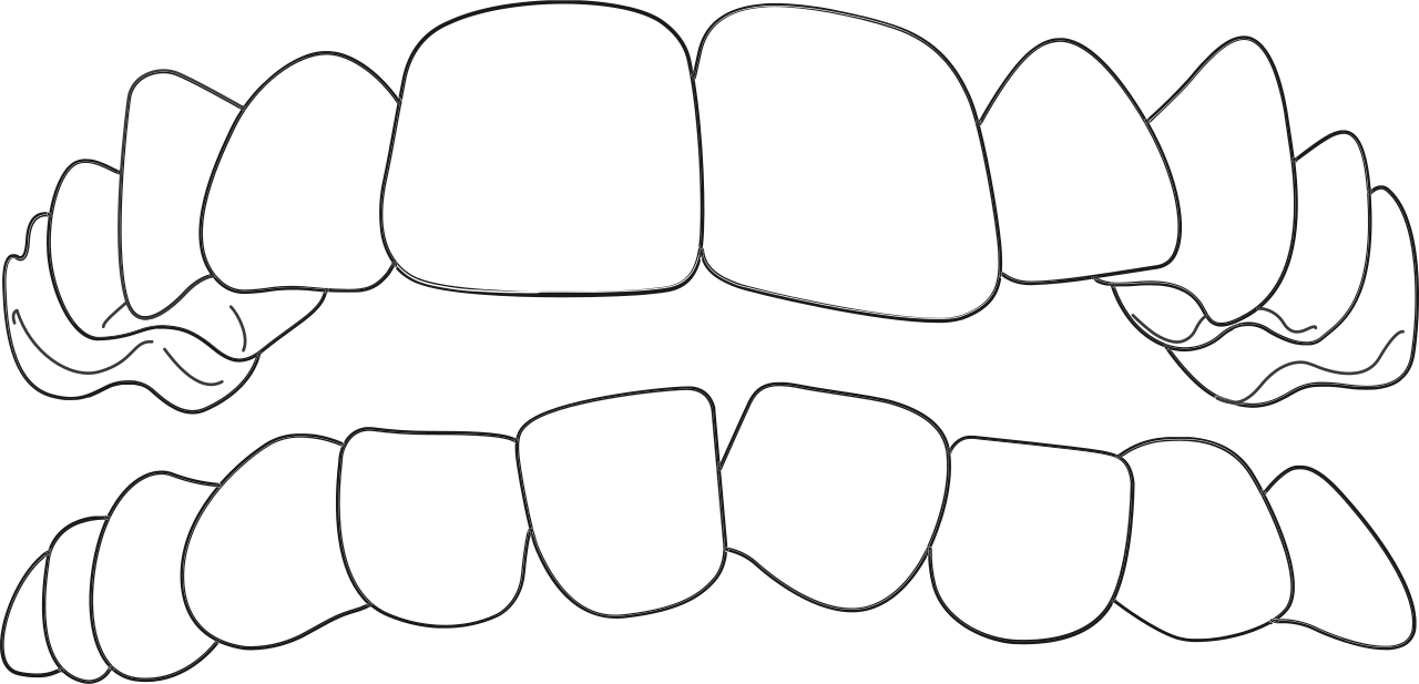 Invisalign