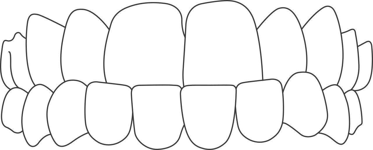Invisalign - Alt dişlerin daha önde olması